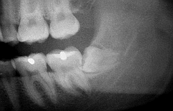 Zahnarzt München: minimalinvasive schmerzarme Weisheitszahnextraktion