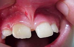 Zahnarzt München: Lippenbändchen minimalinvasiv entfernt