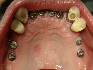Zahnimplantate statt herausnehmbarer Prothesen