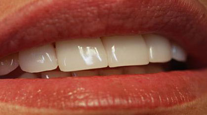 Zahn Veneere aus Keramik