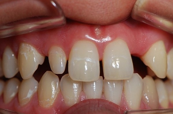 Zahnimplantation München nichtangelegte fehlende Zähne