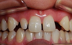 nichtangelegter fehlender Zahn ersetzt