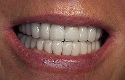 Zahnimplantat München: echte ästhetische Zahnfleischübergänge durch individuell gefräste Abutments