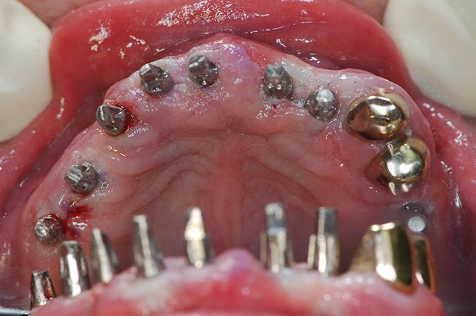 wieder feste zähne an einem Tag minimalinvasives Zahnimplantat