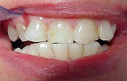 Zahnarzt München: Kunststofffüllungen begradigen von Zähnen