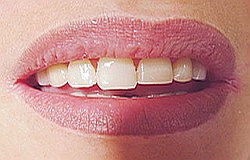 Zahnarzt München: abgekaute Zahnkanten  mit Adhäsivkunststoffen wieder aufgebaut