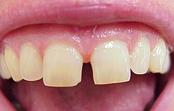 Zahnarzt München: Kunststoff Probeauftrag vor dem endgültigen Schließen der Zahnlücke macht den Patienten sicher
