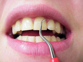 Zahnarzt München: Zahnfleischbehandlung Kürettage Parodontose Behandlung
