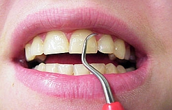 Zahnarzt München: Kürretage reinigt unterhalb  Zahnfleischrand