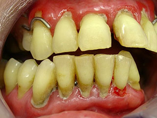 Zahnarzt München: Parodontits Zahnfleischentzündung