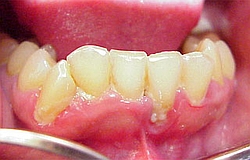 Zahnarzt München: akute Zahnfleischentzündung rotes eitriges Zahnfleisch