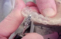 Zahnarzt München: Entlastungsschiene als Schutz vor Zähneknirschen