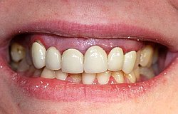 Zahnarzt München: hohes Zahnfleisch Zahnfleischlachen Gummismile