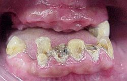 Zahnarzt München keine Scham wegen schlimmer Zähne
