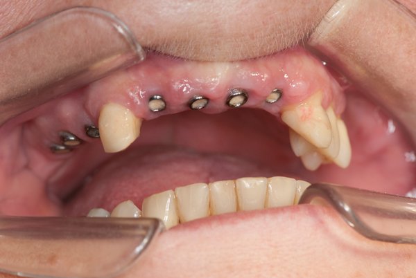 Übersicht Zahnersatz bei Dr. Junk Zahnarzt München