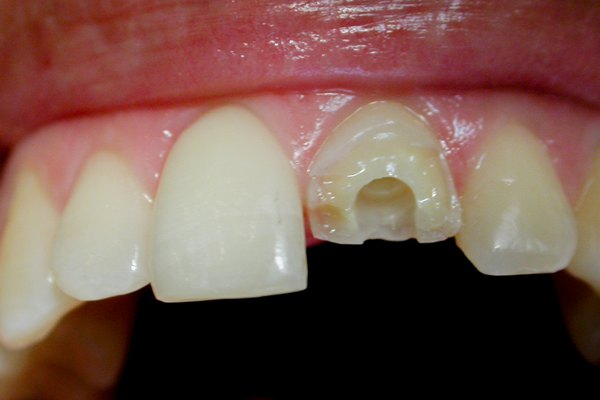 Zahnarzt München Hilfe: Wurzelstift bei abgebrochenem Zahn