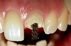 Zahnarzt München: Wurzelstift rettet Zahn nach Zahnbruch
