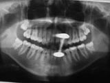 Zahnarzt München: Röntgenbild Strahlung Piercing
