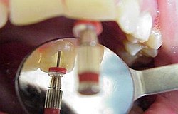 Zahnarzt München: Reinigung Aufbereitung des Wurzelkanals
